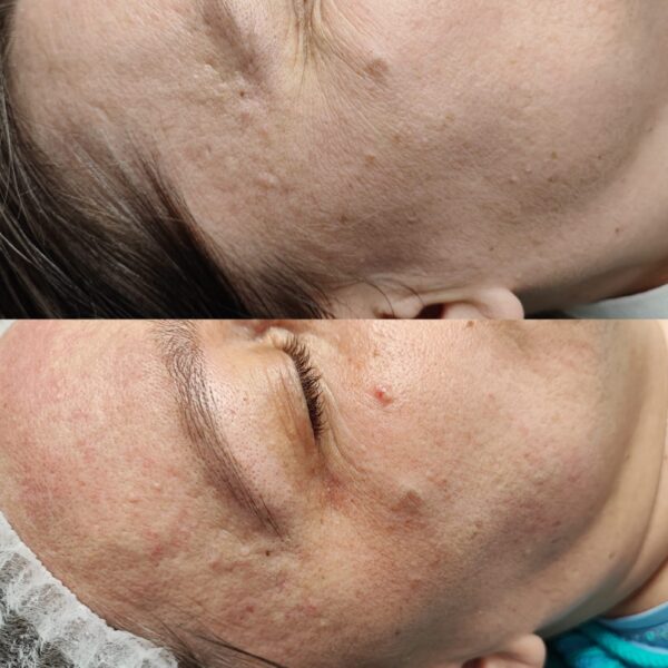 Efekt po mezoterapii mikroigłowej łączonej z kwasami medycznymi