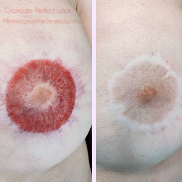 Brodawki-pigmentacja-1-scaled-1