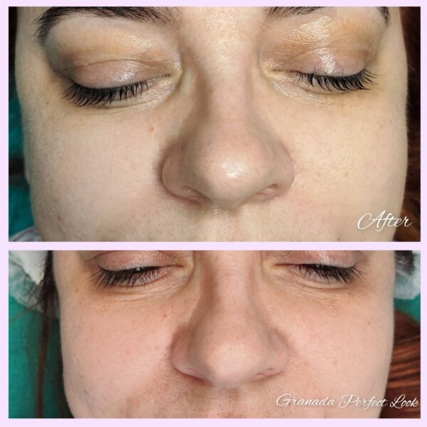 Mezoterapia-Ala-06.2023-scaled-1